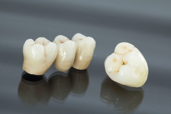 dental crown and dental bridge