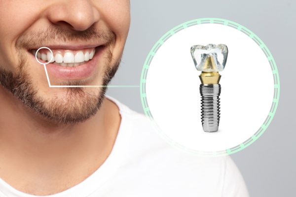 the 3 parts of a dental implant