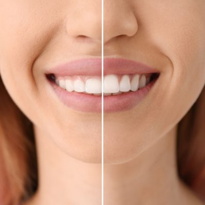 gum contouring