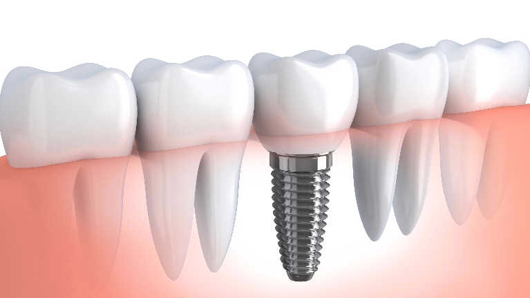 Dental Implants in Smyrna, DE | Dr. Brian Wisk, Glenwood Dental