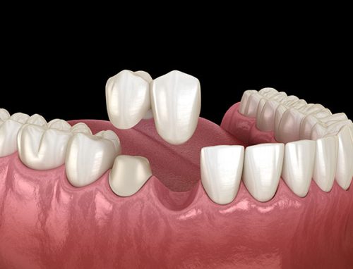 cantilever dental bridge