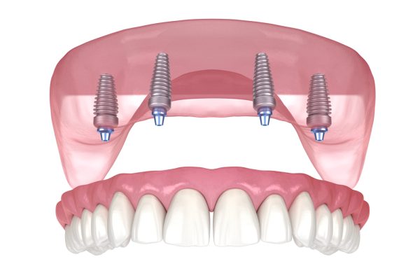 implant-supported dentures