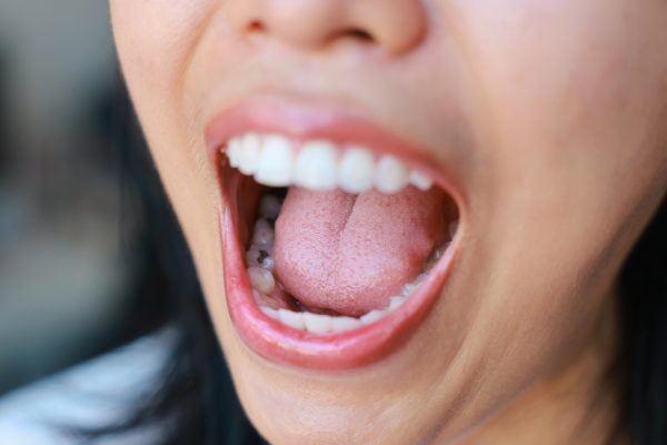 woman with cavities and tooth decay in back teeth