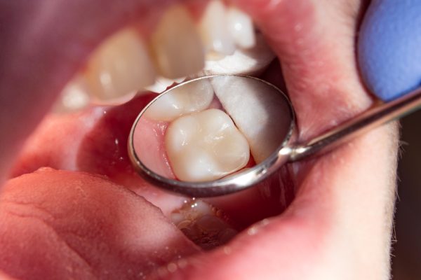 tooth-colored dental fillings