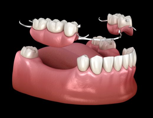 3D rendering of partial dentures with clasps, illustrating dental prosthetics designed to replace missing teeth, showcasing comfort and aesthetics in restorative dentistry.