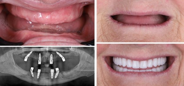 Images of dental procedures: upper jaw with immediate dentures, lower jaw with implant-supported denture, X-ray showing dental implants, and a smiling patient with complete dentures, illustrating the process and benefits of dentures at Glenwood Dental Associates.