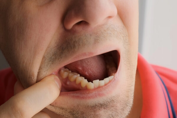 dental abscess